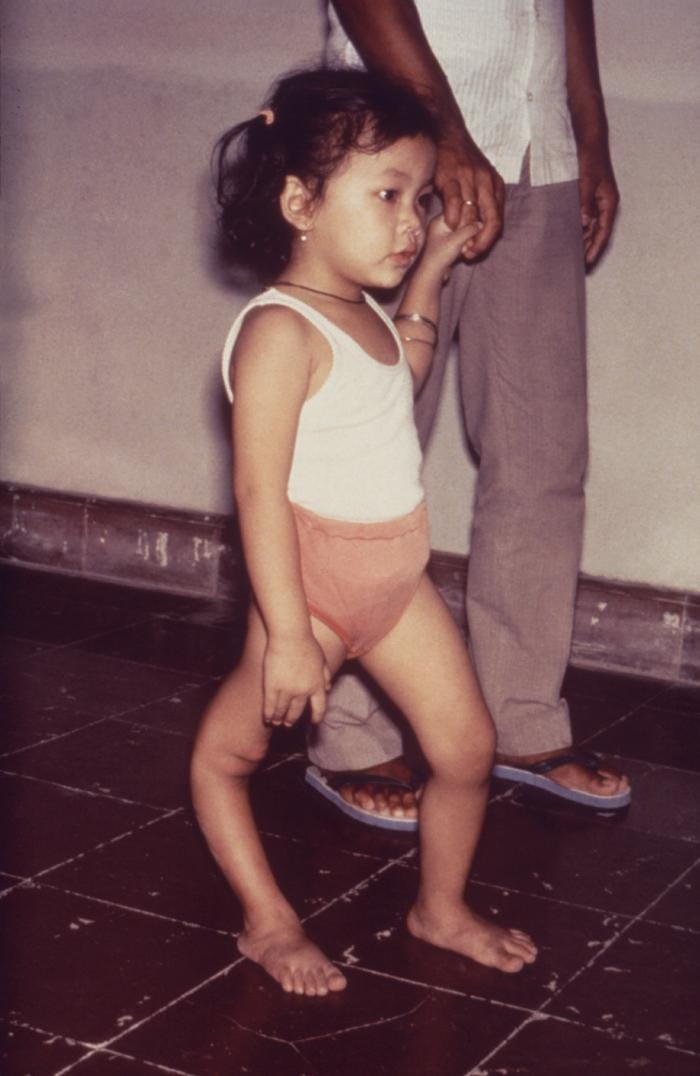 A small child is holding an adult's hand while walking. The child's right leg has been visibly deformed by polio infection.